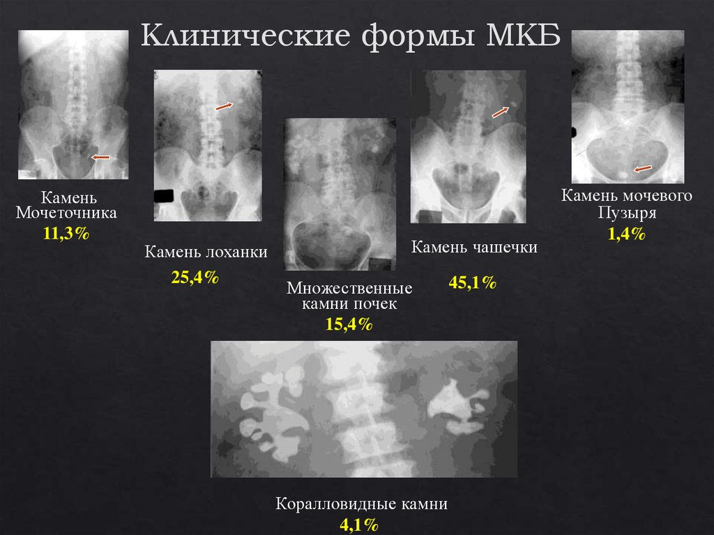 Мочеточник у кошек. Клинические формы мочекаменной болезни. Мкб. Коралловидный камень почки степени. Мочекаменная болезнь камни в мочевом пузыре. Мочекаменная болезнь клинический диагноз.