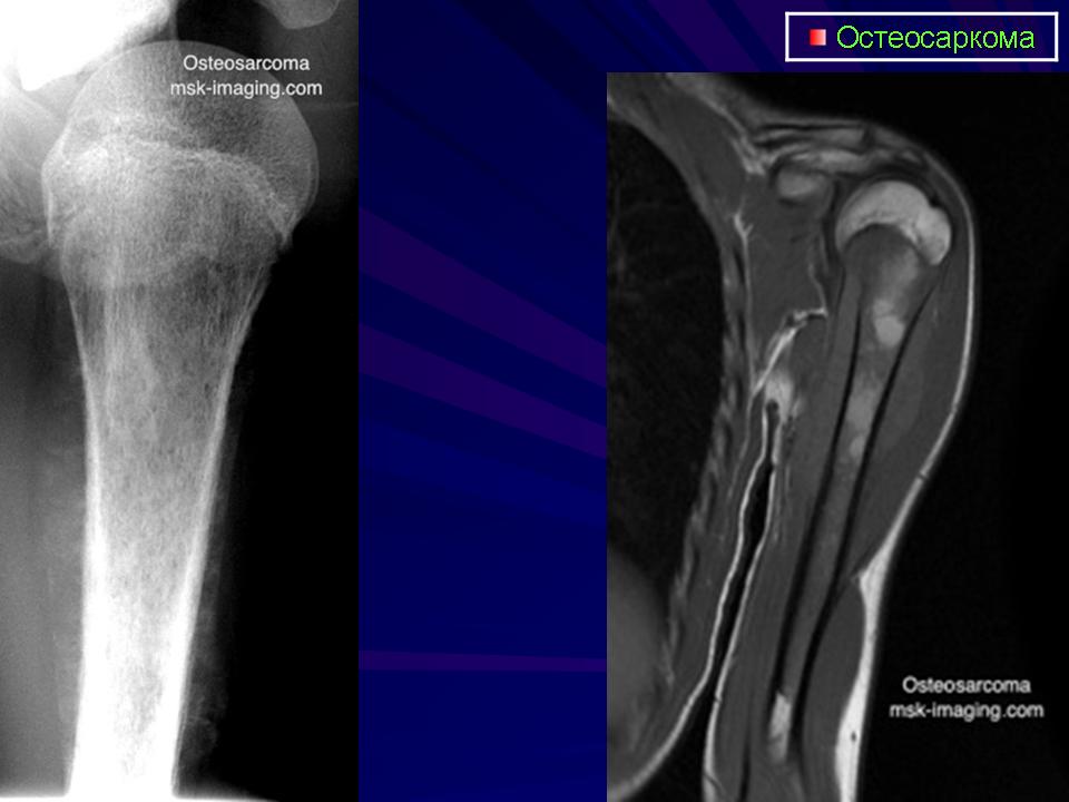 Костные саркомы. Саркома Юинга бедренной кости кт. Саркома Юинга плечевой кости на кт. Остеогенная саркома бедренной кости кт. Остеосаркома плечевой кости рентген.