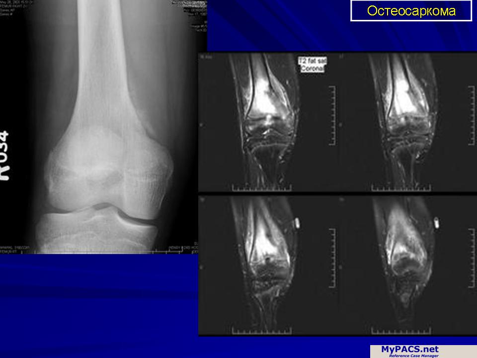 Рак кости ноги. Остеосаркома коленного сустава рентген. Остеосаркома рентген признаки.