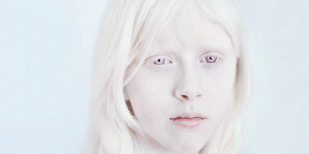 Альбинизмом страдают. Лэйни чэнг альбинос.