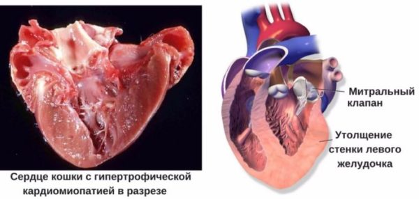 Изображение пораженного патологией сердц