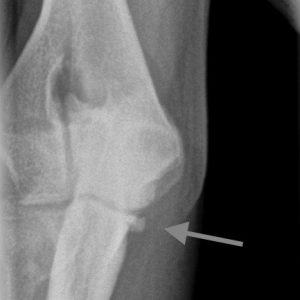 dog elbow fracture